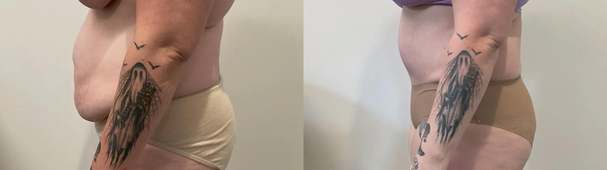 Tummy Tuck Before & After Gallery - Patient 817430 - Image 5