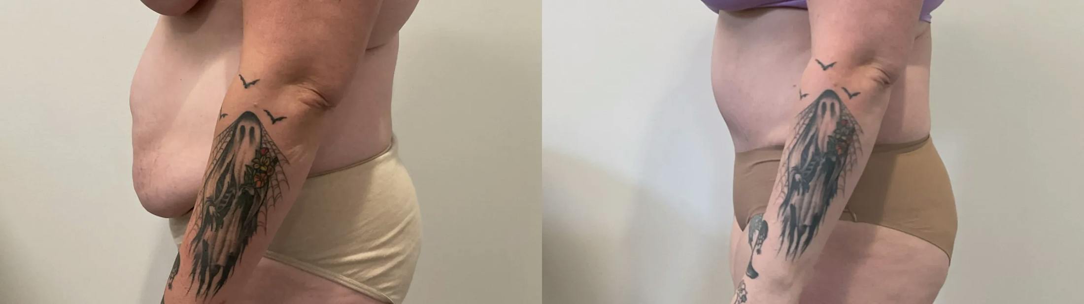 Tummy Tuck Before & After Gallery - Patient 817430 - Image 5