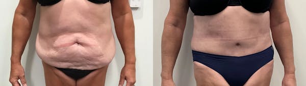 Tummy Tuck Before & After Gallery - Patient 791597 - Image 1