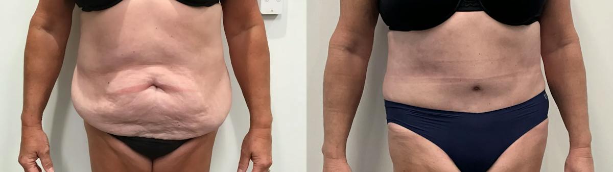 Tummy Tuck Before & After Gallery - Patient 791597 - Image 1