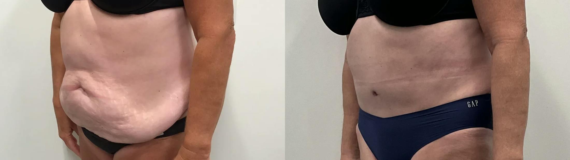 Tummy Tuck Before & After Gallery - Patient 791597 - Image 2