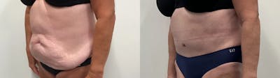 Tummy Tuck Before & After Gallery - Patient 791597 - Image 2