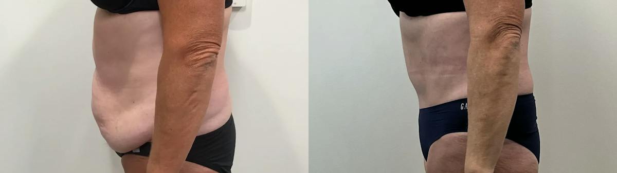 Tummy Tuck Before & After Gallery - Patient 791597 - Image 3