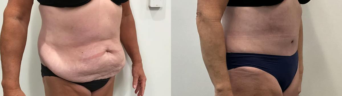 Tummy Tuck Before & After Gallery - Patient 791597 - Image 4