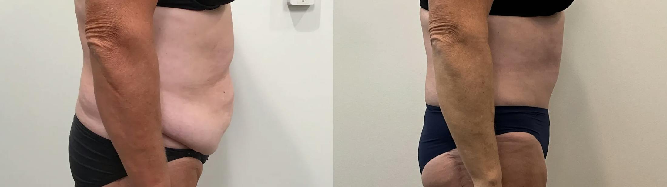 Tummy Tuck Before & After Gallery - Patient 791597 - Image 5