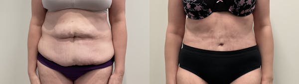 Tummy Tuck Before & After Gallery - Patient 188137 - Image 1