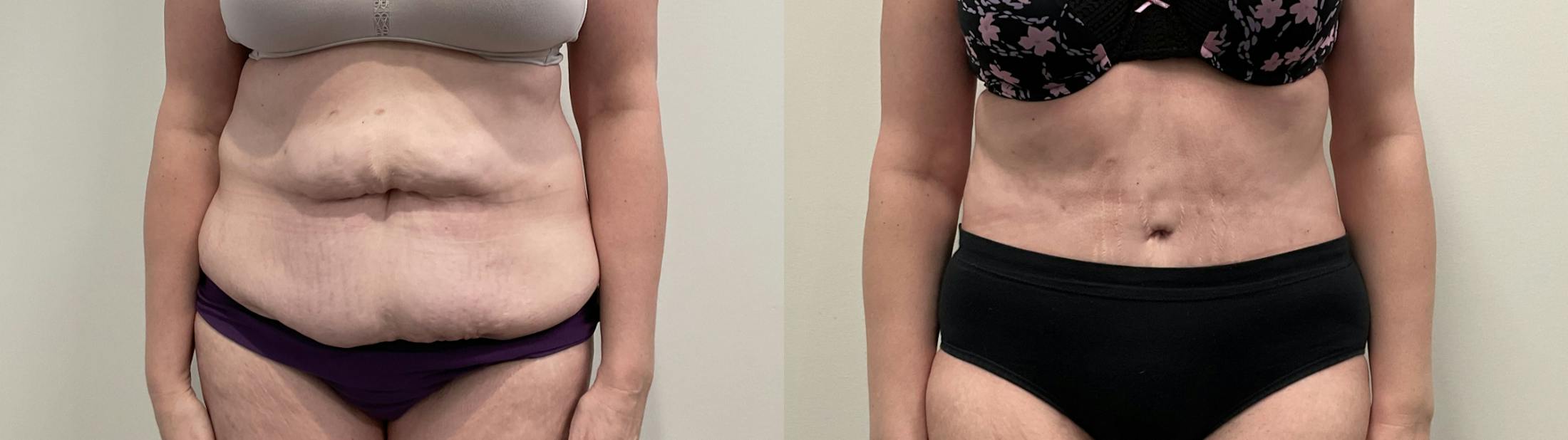 Tummy Tuck Before & After Gallery - Patient 188137 - Image 1