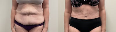 Tummy Tuck Before & After Gallery - Patient 188137 - Image 1