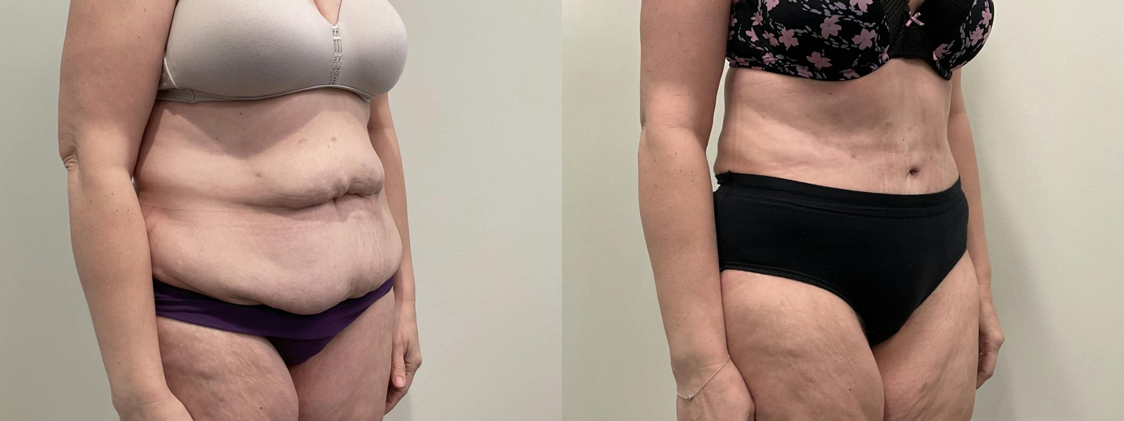 Tummy Tuck Before & After Gallery - Patient 188137 - Image 2