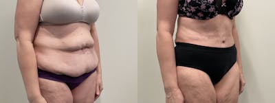 Tummy Tuck Before & After Gallery - Patient 188137 - Image 2