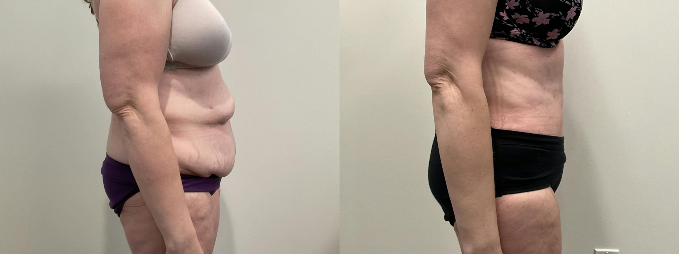 Tummy Tuck Before & After Gallery - Patient 188137 - Image 3