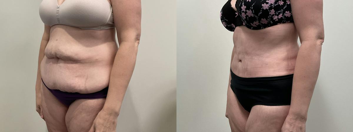 Tummy Tuck Before & After Gallery - Patient 188137 - Image 4