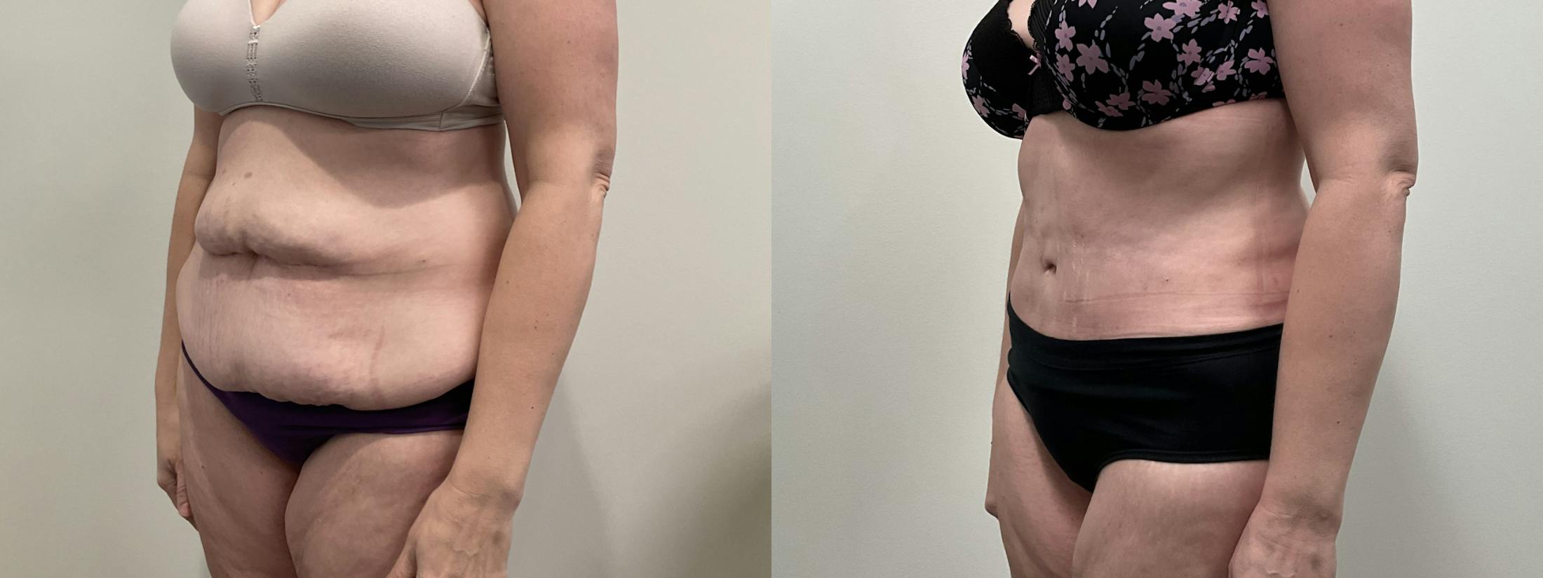 Tummy Tuck Before & After Gallery - Patient 188137 - Image 4