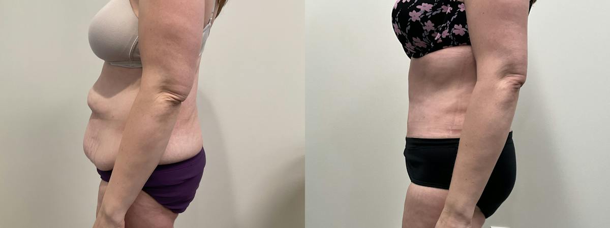 Tummy Tuck Before & After Gallery - Patient 188137 - Image 5