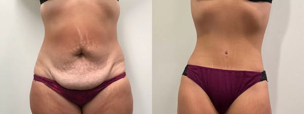 Tummy Tuck Before & After Gallery - Patient 110152 - Image 1