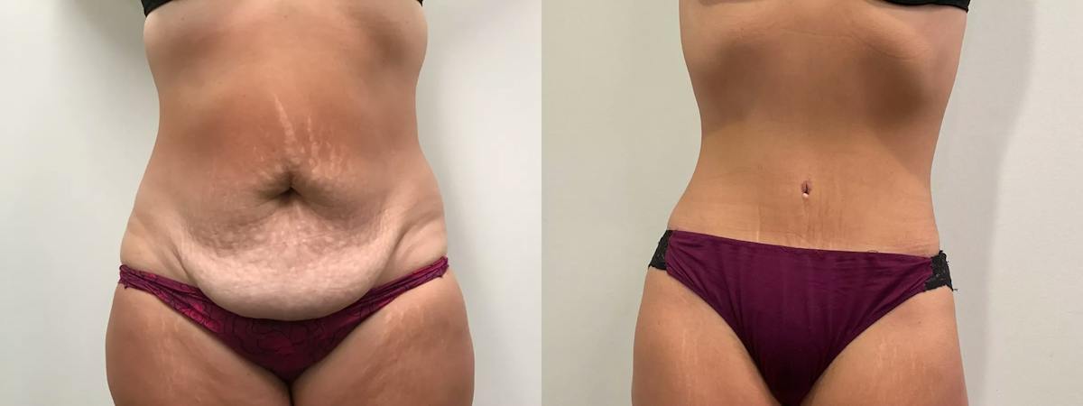 Tummy Tuck Before & After Gallery - Patient 110152 - Image 1