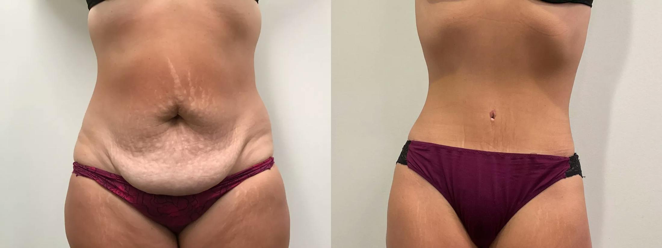 Tummy Tuck Before & After Gallery - Patient 110152 - Image 1