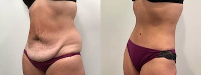 Tummy Tuck Before & After Gallery - Patient 110152 - Image 2