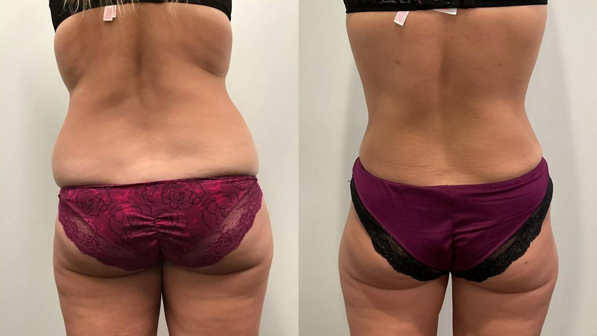 Tummy Tuck Before & After Gallery - Patient 110152 - Image 3