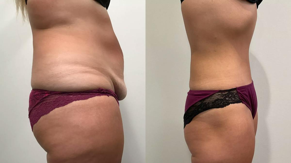 Tummy Tuck Before & After Gallery - Patient 110152 - Image 4