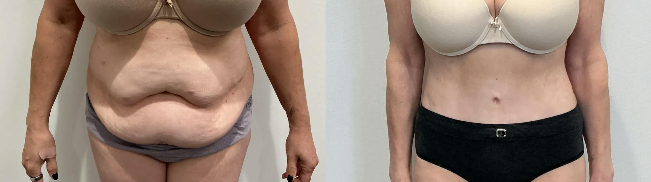 Tummy Tuck Before & After Gallery - Patient 354578 - Image 1