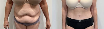 Tummy Tuck Before & After Gallery - Patient 354578 - Image 1