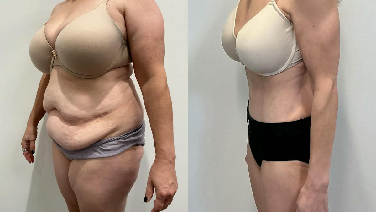 Tummy Tuck Before & After Gallery - Patient 354578 - Image 2