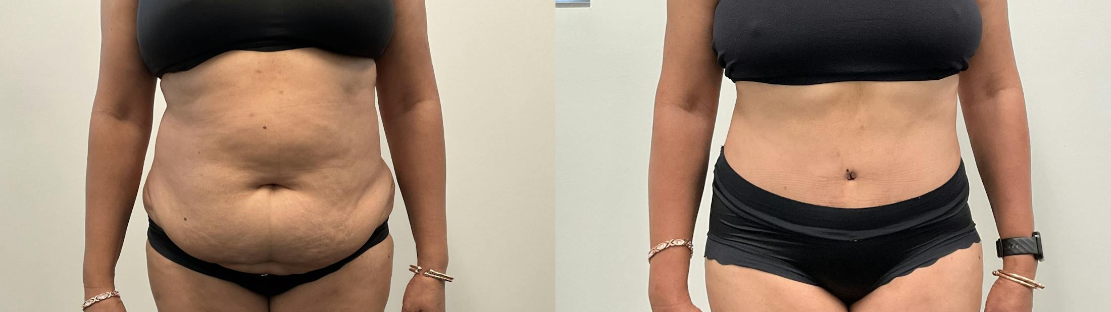 Tummy Tuck Before & After Gallery - Patient 295424 - Image 1
