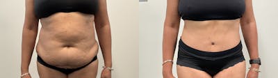 Tummy Tuck Before & After Gallery - Patient 295424 - Image 1