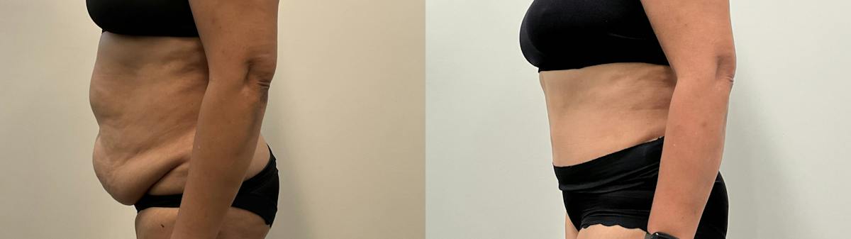 Tummy Tuck Before & After Gallery - Patient 295424 - Image 2