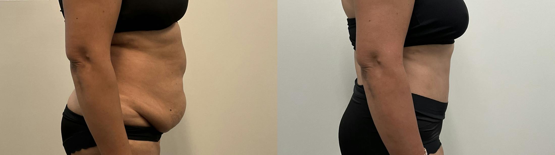Tummy Tuck Before & After Gallery - Patient 295424 - Image 3