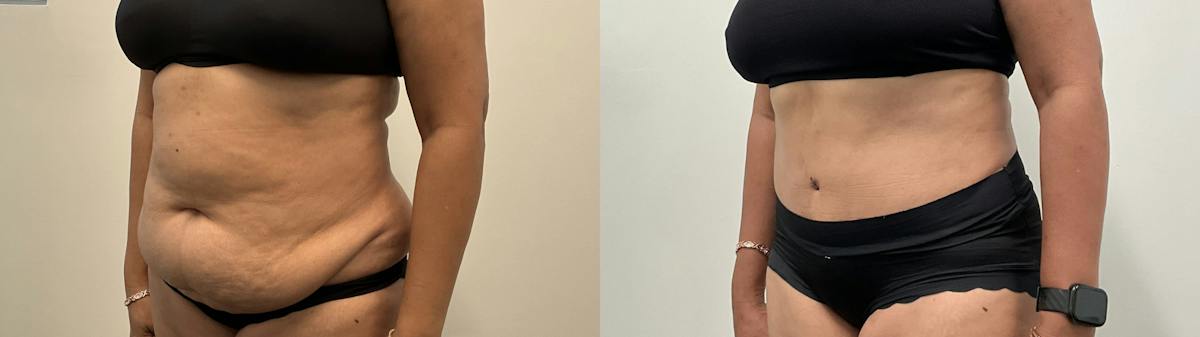 Tummy Tuck Before & After Gallery - Patient 295424 - Image 4