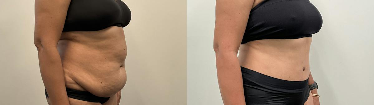 Tummy Tuck Before & After Gallery - Patient 295424 - Image 5