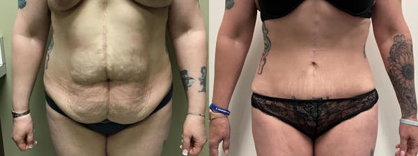 Tummy Tuck Before & After Gallery - Patient 634808 - Image 1