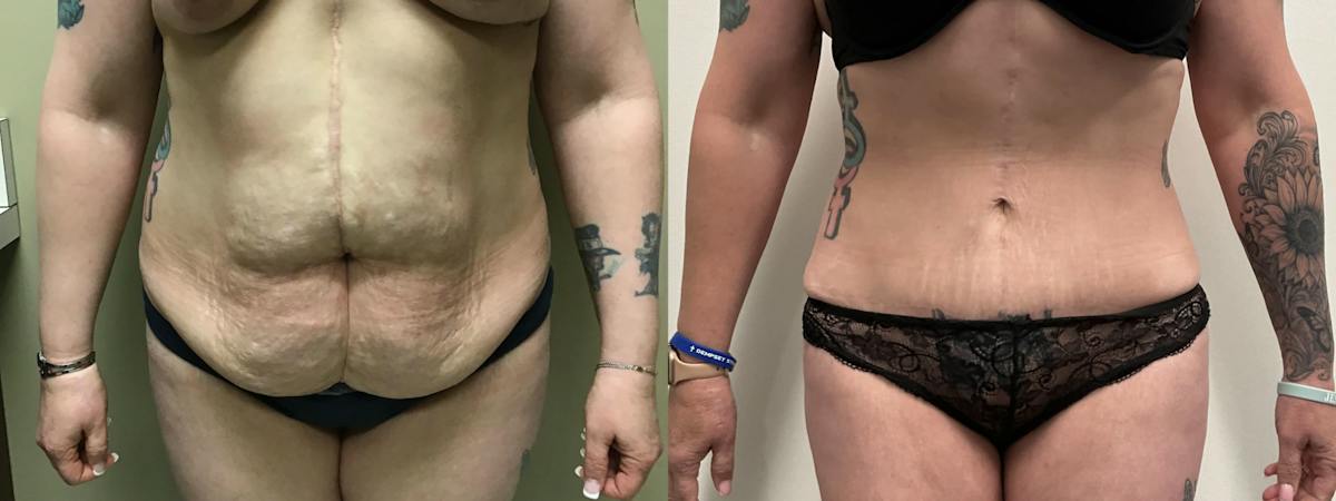 Tummy Tuck Before & After Gallery - Patient 634808 - Image 1
