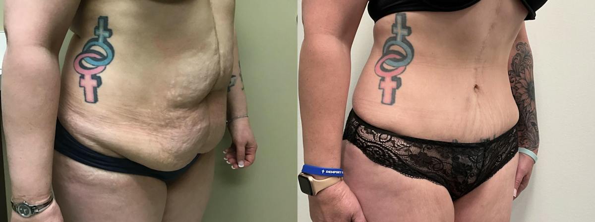 Tummy Tuck Before & After Gallery - Patient 634808 - Image 2