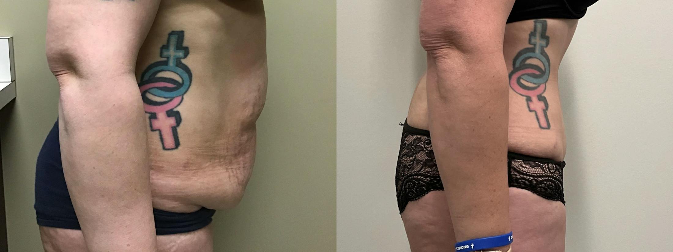 Tummy Tuck Before & After Gallery - Patient 634808 - Image 3