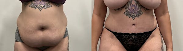 Tummy Tuck Before & After Gallery - Patient 373081 - Image 1