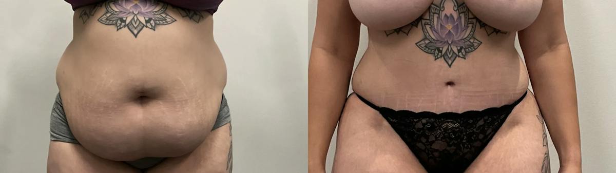 Tummy Tuck Before & After Gallery - Patient 373081 - Image 1