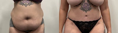 Tummy Tuck Before & After Gallery - Patient 373081 - Image 1