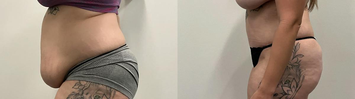 Tummy Tuck Before & After Gallery - Patient 373081 - Image 2