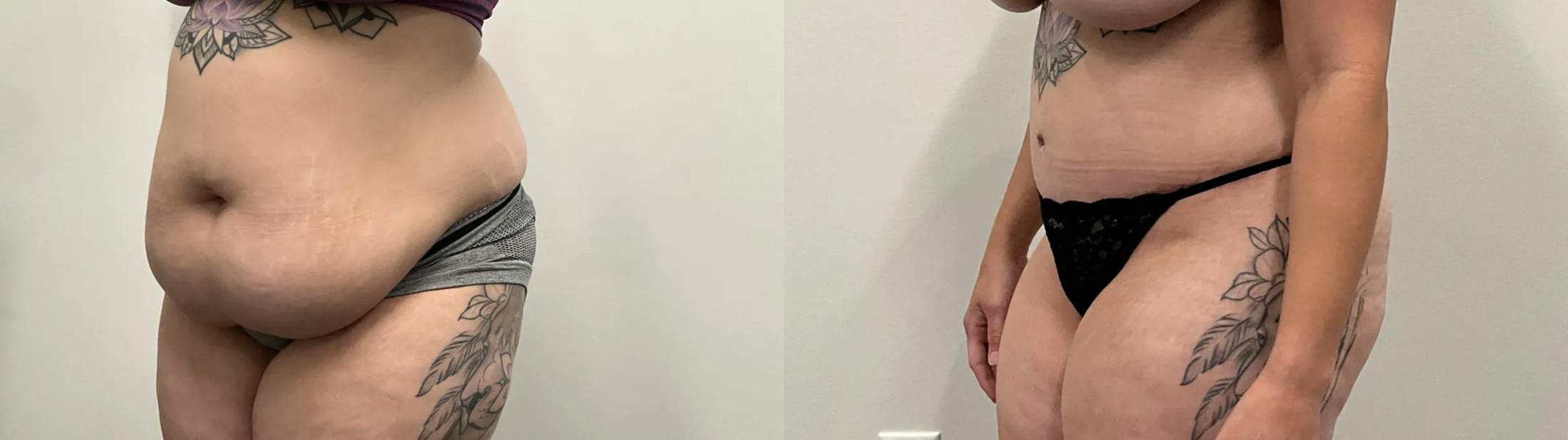 Tummy Tuck Before & After Gallery - Patient 373081 - Image 3