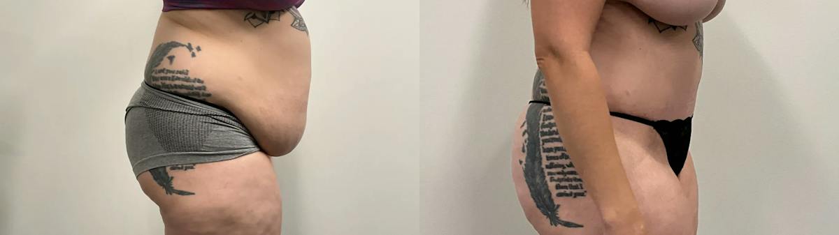 Tummy Tuck Before & After Gallery - Patient 373081 - Image 4