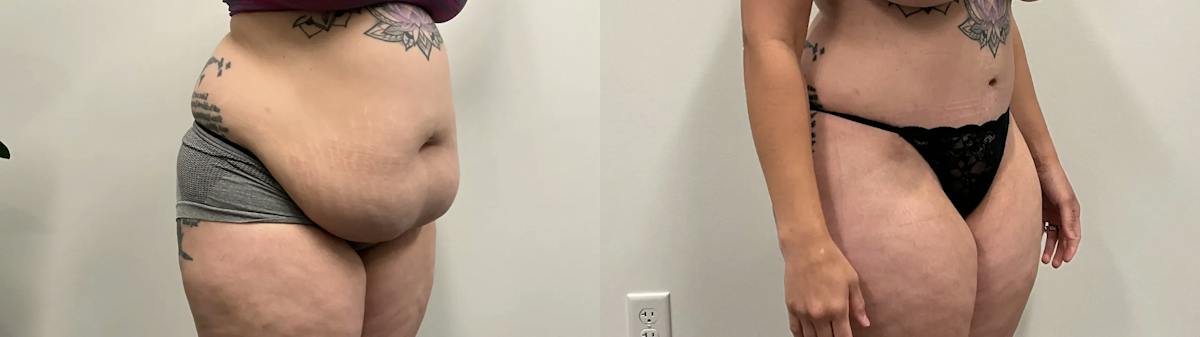 Tummy Tuck Before & After Gallery - Patient 373081 - Image 5