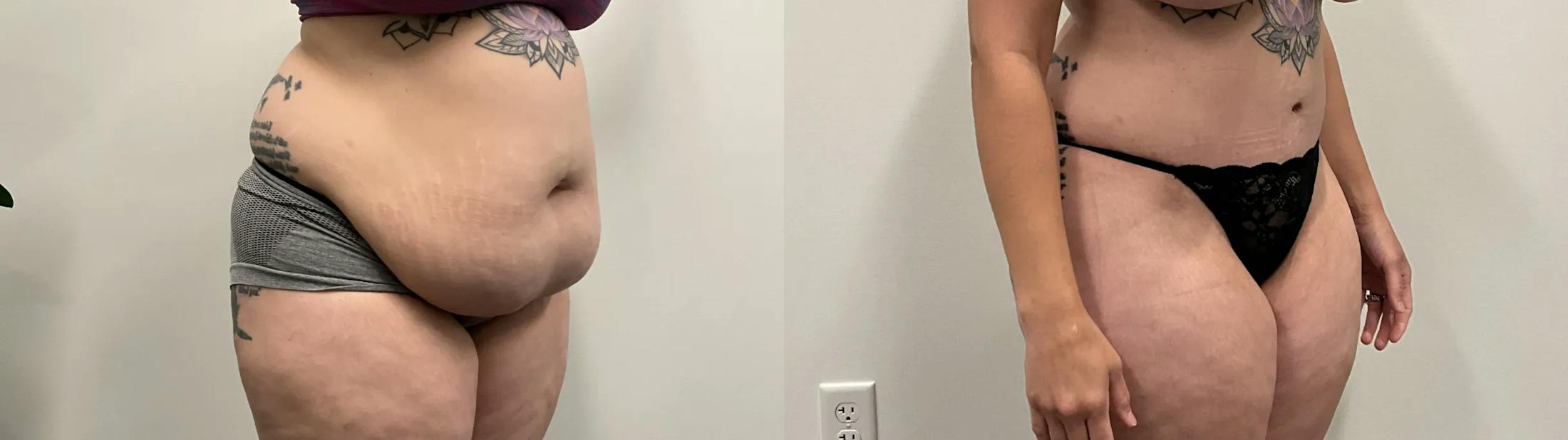 Tummy Tuck Before & After Gallery - Patient 373081 - Image 5