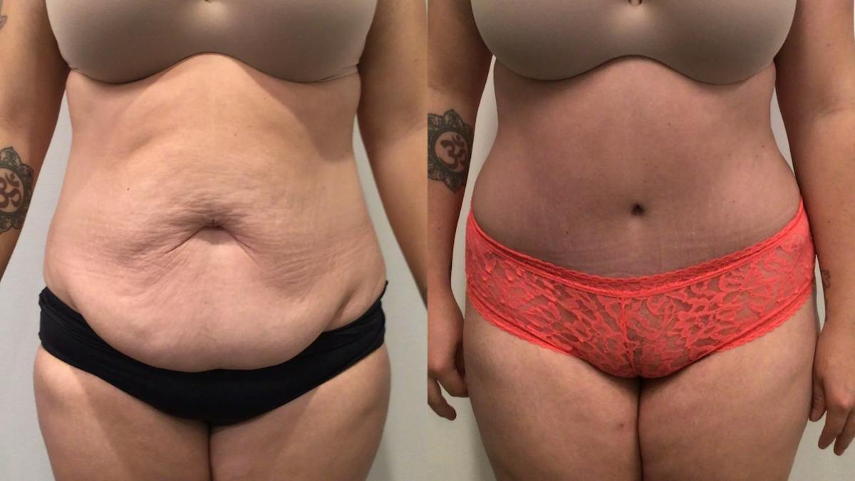 Tummy Tuck Before & After Gallery - Patient 300777 - Image 1
