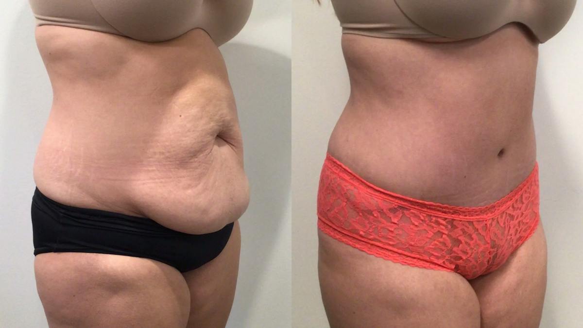 Tummy Tuck Before & After Gallery - Patient 300777 - Image 2
