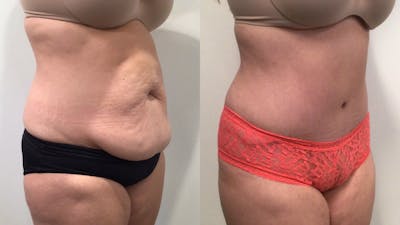 Tummy Tuck Before & After Gallery - Patient 300777 - Image 2