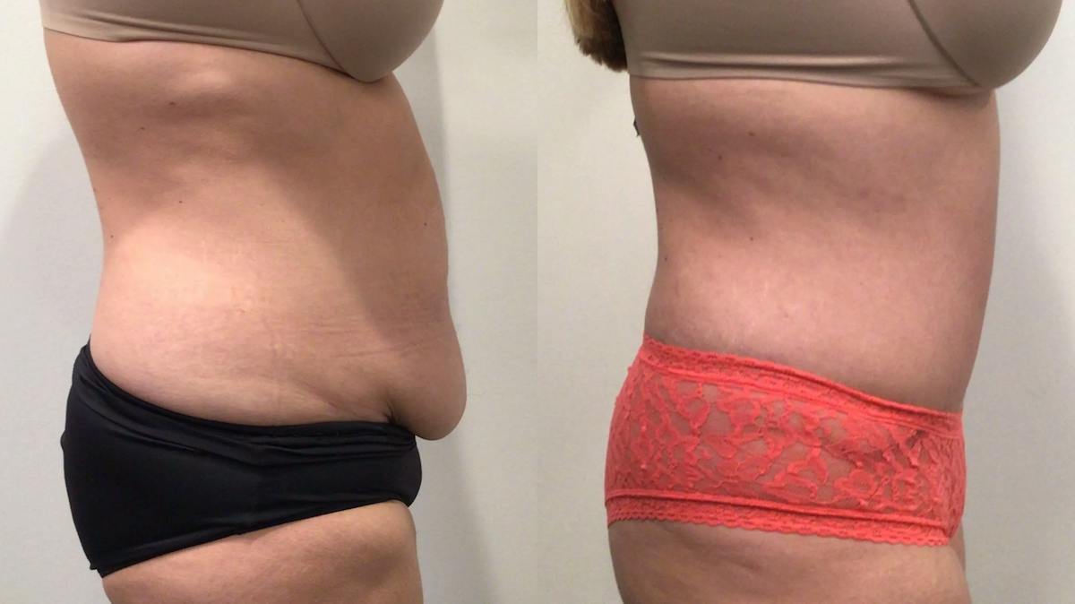 Tummy Tuck Before & After Gallery - Patient 300777 - Image 3