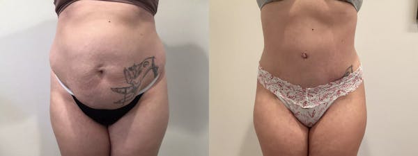 Tummy Tuck Before & After Gallery - Patient 351274 - Image 1